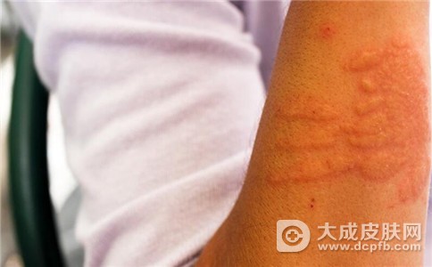 荨麻疹久治不愈的原因