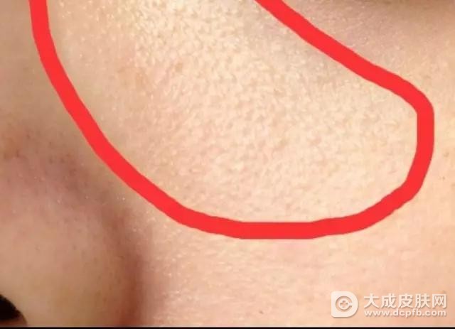 黑头粉刺形成的原因