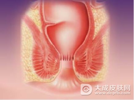 肛周湿疹太困扰 教你偏方
