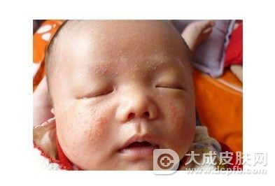 婴儿湿疹该怎么护理