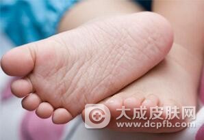 预防手足皲裂教你妙招