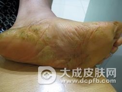 冬季手足皲裂有哪些原因
