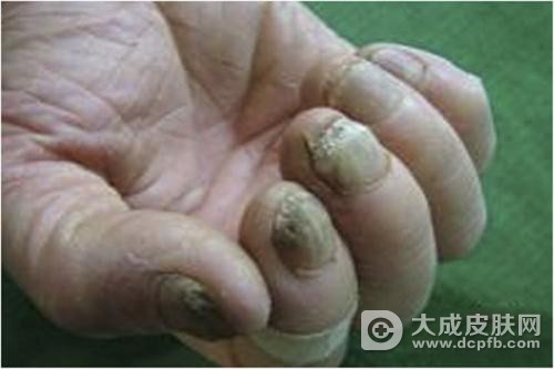 灰指甲是哪些原因引起的