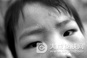春季如何改善脸脱皮