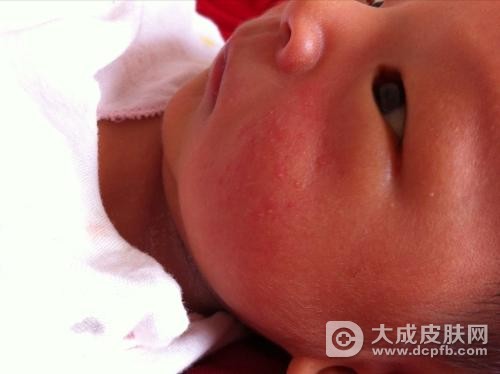 宝宝脸上长湿疹该怎么预防