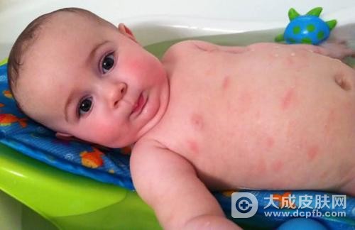宝宝出现皮炎有哪些护理措施