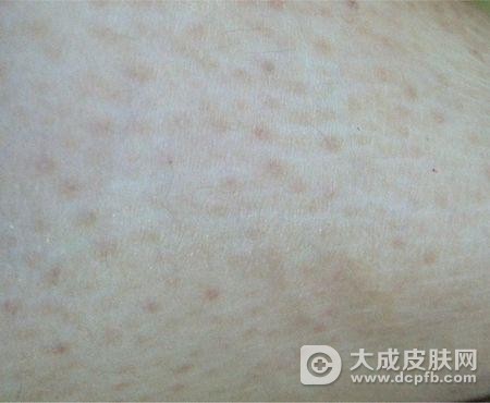 改善毛周角化症要注意哪些