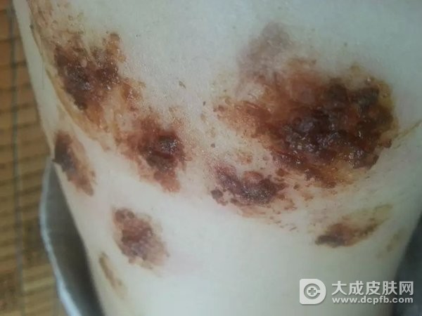 带状疱疹饮食注意的事项