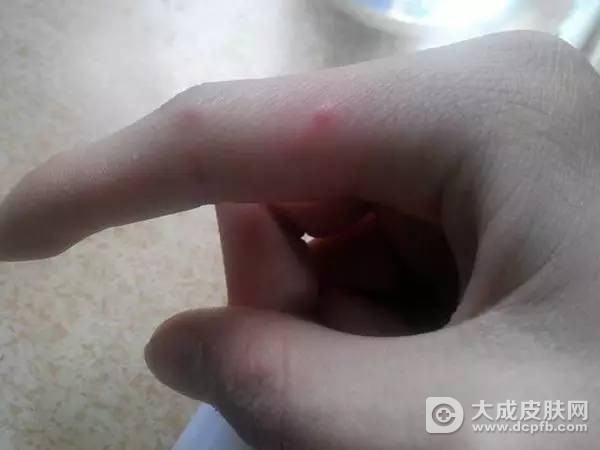春季急疹麻疹水痘怎么防