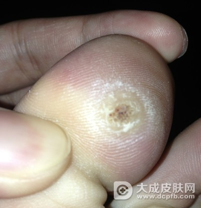足底长硬结 竟是跖疣