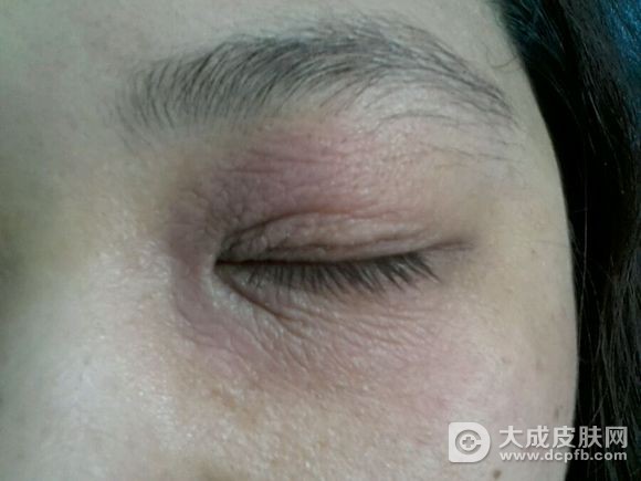 如何预防神经性皮炎出现