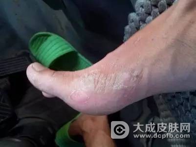 得了足癣该怎么办