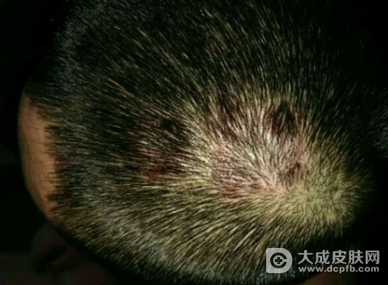 牛皮癣与头癣的区别