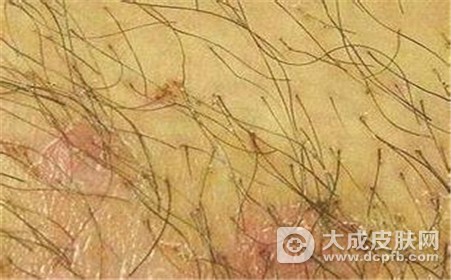 阴虱病的原因和症状表现