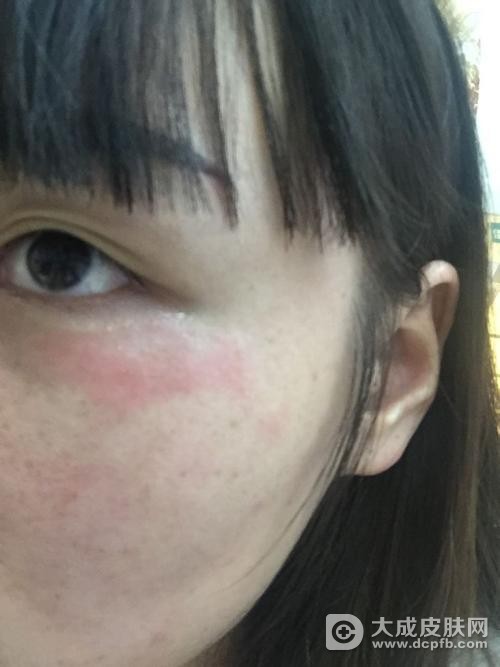 脸上长红斑的原因有哪些