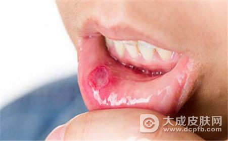 改善口腔溃疡的偏方