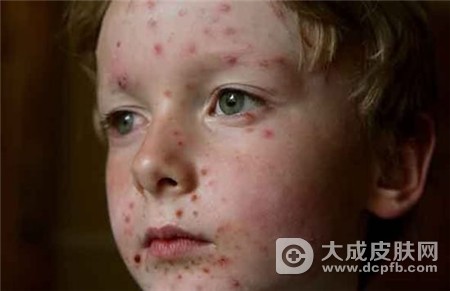 新疆一宝宝患“水痘”转危为安
