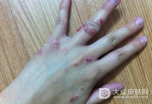 夏季宝宝湿疹怎么办