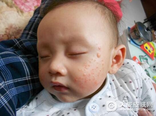宝宝湿疹是哪些因素导致的