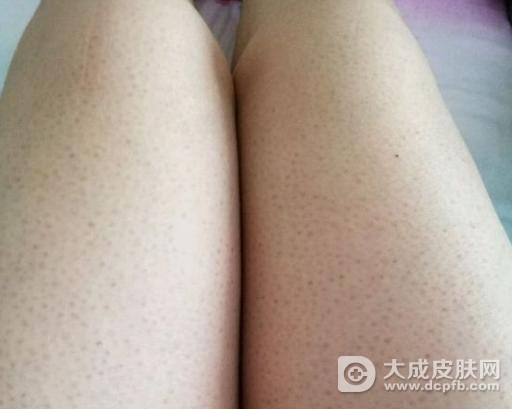 毛周角化症该怎么护理
