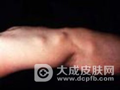 脂肪肉瘤和脂肪粒有哪些区别