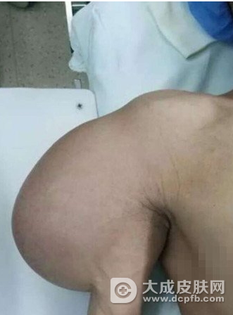 男子手臂上挂脂肪瘤近30年重达8斤