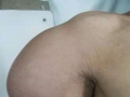 男子手臂上挂脂肪瘤近30年 重达8斤