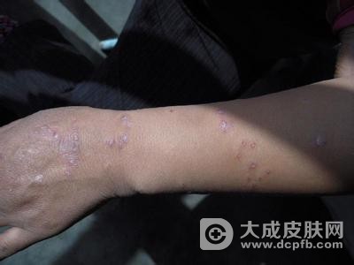 牛皮癣是哪些因素引起的