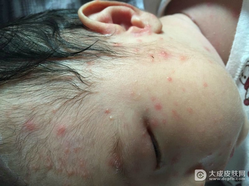 孩子长水痘该怎么护理