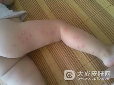 春季小心丘疹性荨麻疹多发