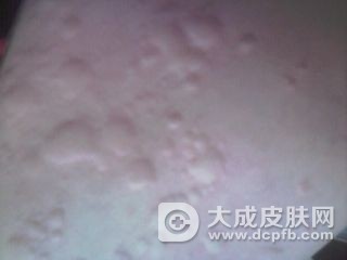女子一瓶啤酒下肚竟呼吸困难 皮肤冒红斑