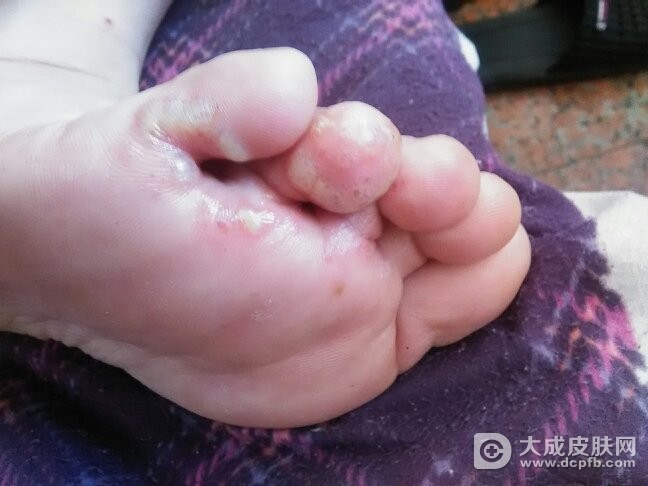 春季脚气加重的原因有哪些