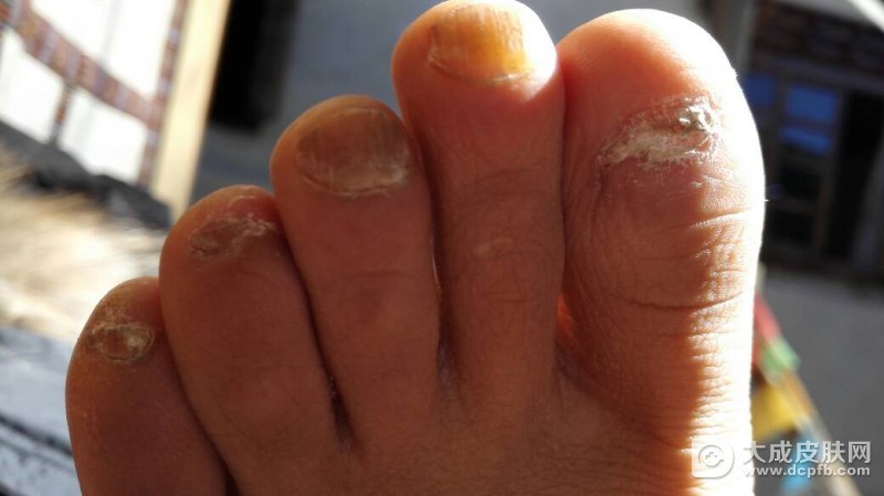 灰指甲的症状 预防方法有哪些