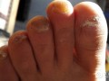 灰指甲的症状  预防方法有哪些