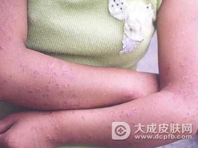 春季如何预防皮炎出现