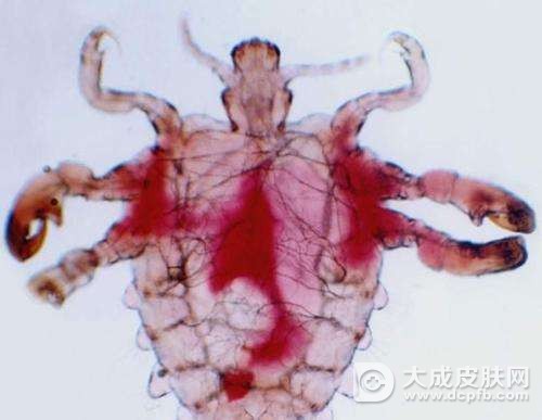 阴虱病怎么治疗好