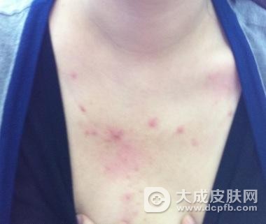 身上毛囊炎怎么办