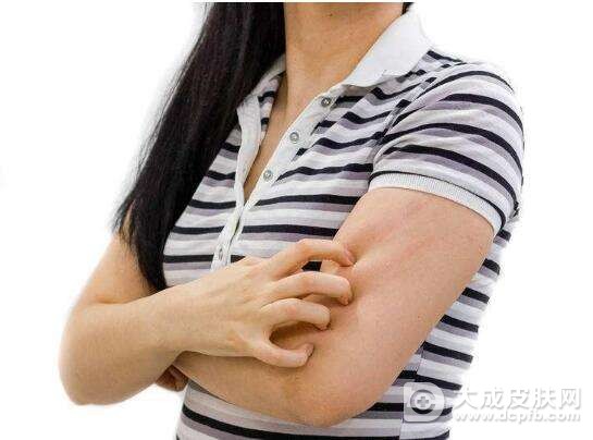 成人湿疹病因