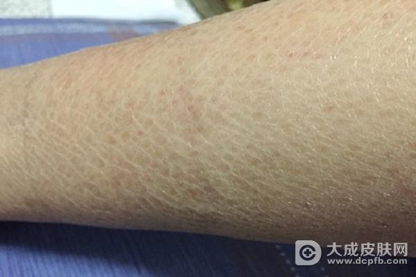 鱼鳞病的症状与治疗