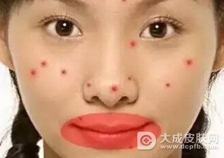 脸上的痘痘越来越多