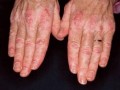 皮肌炎可能会造成的危害