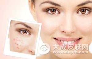 成人也会长青春痘该怎么办