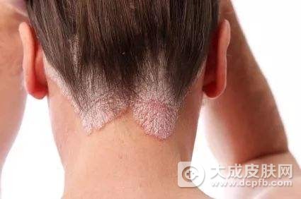 银屑病的症状有哪些