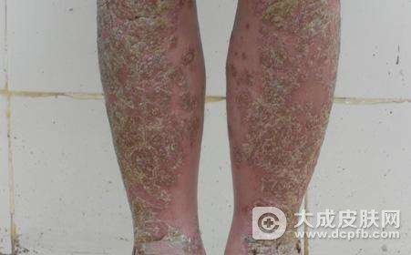 银屑病的治疗