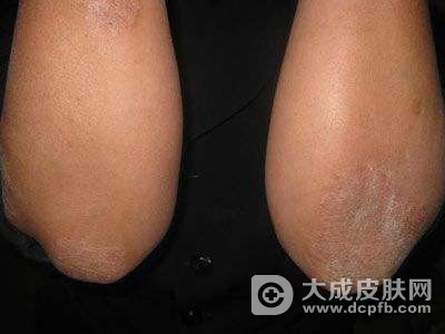 神经性皮炎怎么回事