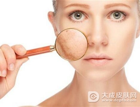 脸上的痤疮怎么能消除