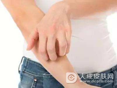 荨麻疹患者不能吃什么