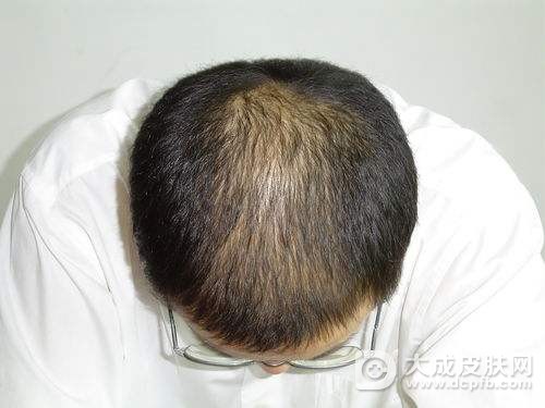 脱发要怎么改善