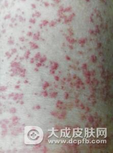 玫瑰糠疹对孩子的危害有哪些