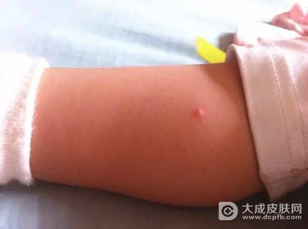 水痘就是带状疱疹吗